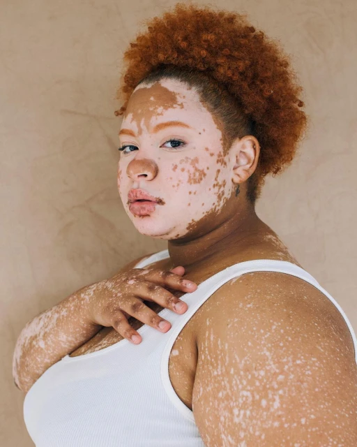 Portrait of a confident adult woman with vitiligo in a white tank top against a tan backdrop, showcasing natural beauty.