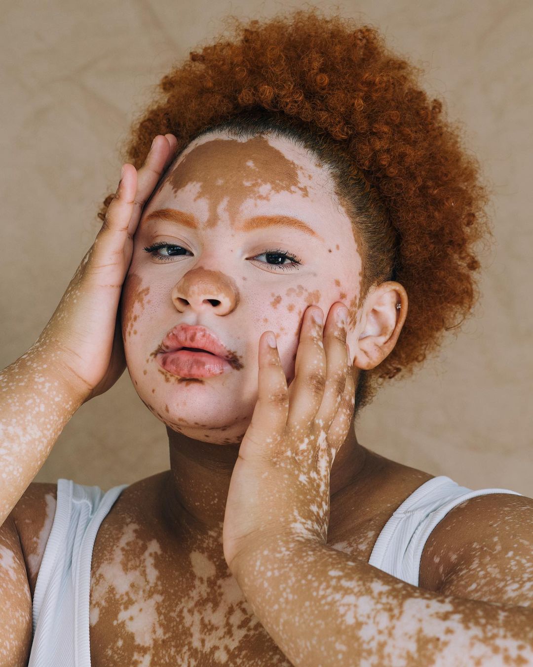 Close-up portrait of a woman with vitiligo, showcasing her face and upper body against a neutral background with natural light.