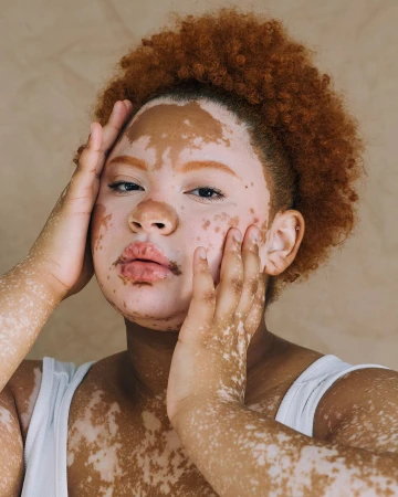 Close-up portrait of a woman with vitiligo, showcasing her face and upper body against a neutral background with natural light.
