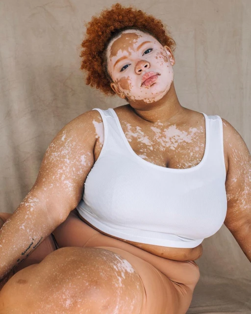Portrait of a young adult female with vitiligo, curly red hair, wearing a white tank top, and sitting against a neutral background.