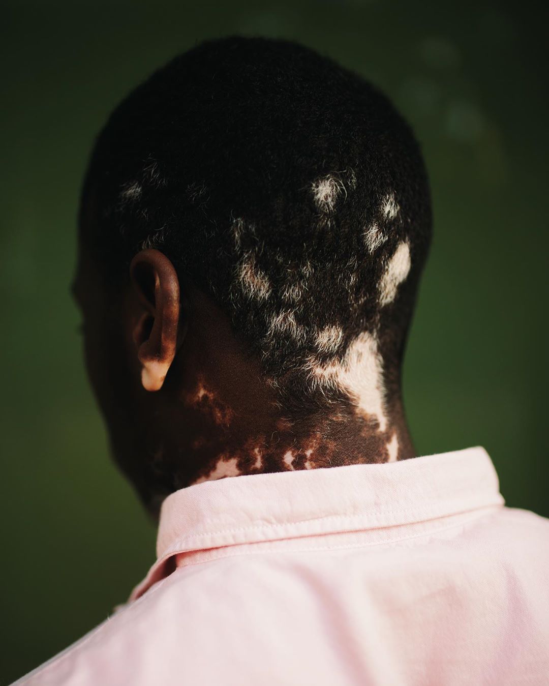 Close-up of a Black adult male with vitiligo, wearing a pink collared shirt, against a blurred green background in soft, diffused lighting.