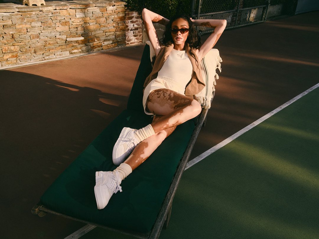 An adult woman with vitiligo in white sneakers and lounge clothes poses on a lounger in a sunny outdoor setting with a stone wall.
