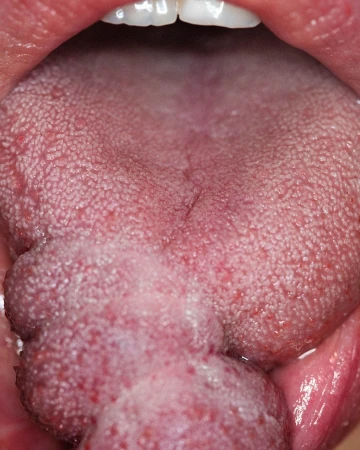 Open mouth view shows tongue with swelling. Teeth are visible at the top, and the inside of the mouth is illuminated.