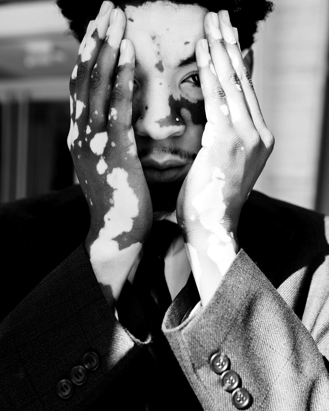 Monochrome portrait of a male adult with vitiligo, hands framing his face, wearing a suit jacket and tie indoors, captured in black and white.