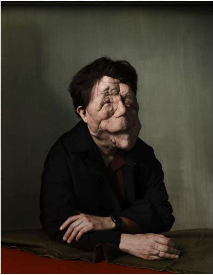 Portrait of an adult with a visible skin condition posing indoors, wearing a black jacket, with muted green and brown tones in the background.