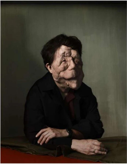 Portrait of an adult with a visible skin condition posing indoors, wearing a black jacket, with muted green and brown tones in the background.