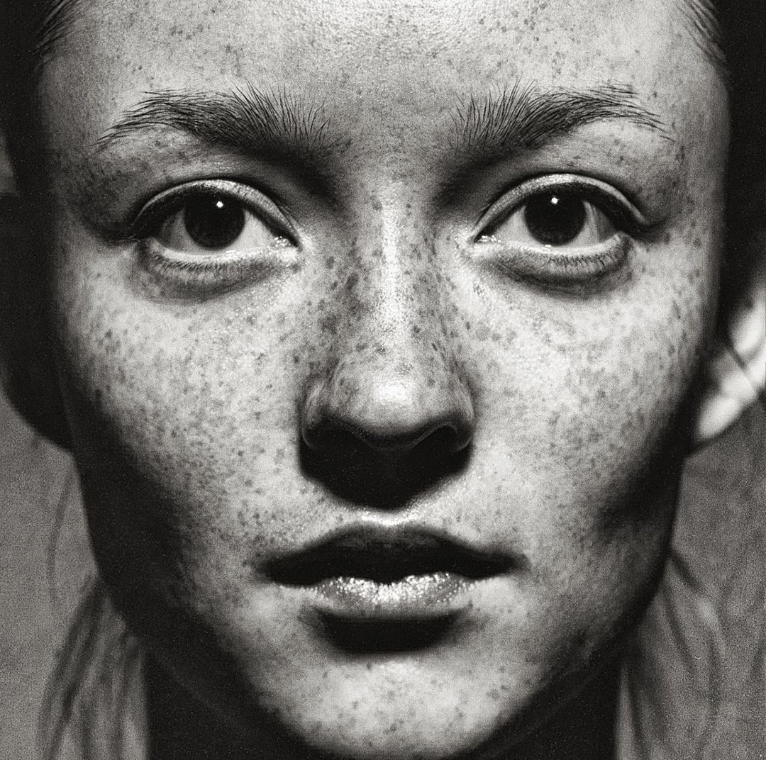 Extreme close-up monochrome portrait of a woman's face covered in detailed freckles with direct high-contrast lighting by Patric Shaw.