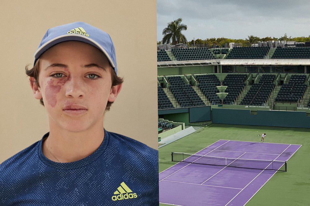 Young male tennis player with a port-wine stain on his face wearing an Adidas cap and shirt in front of tennis court seating.