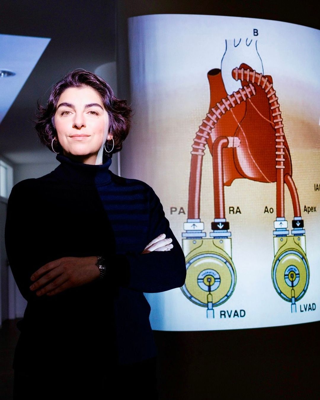 Adult woman with crossed arms stands in front of medical diagram of a heart with external ventricular assist devices (RVAD and LVAD).