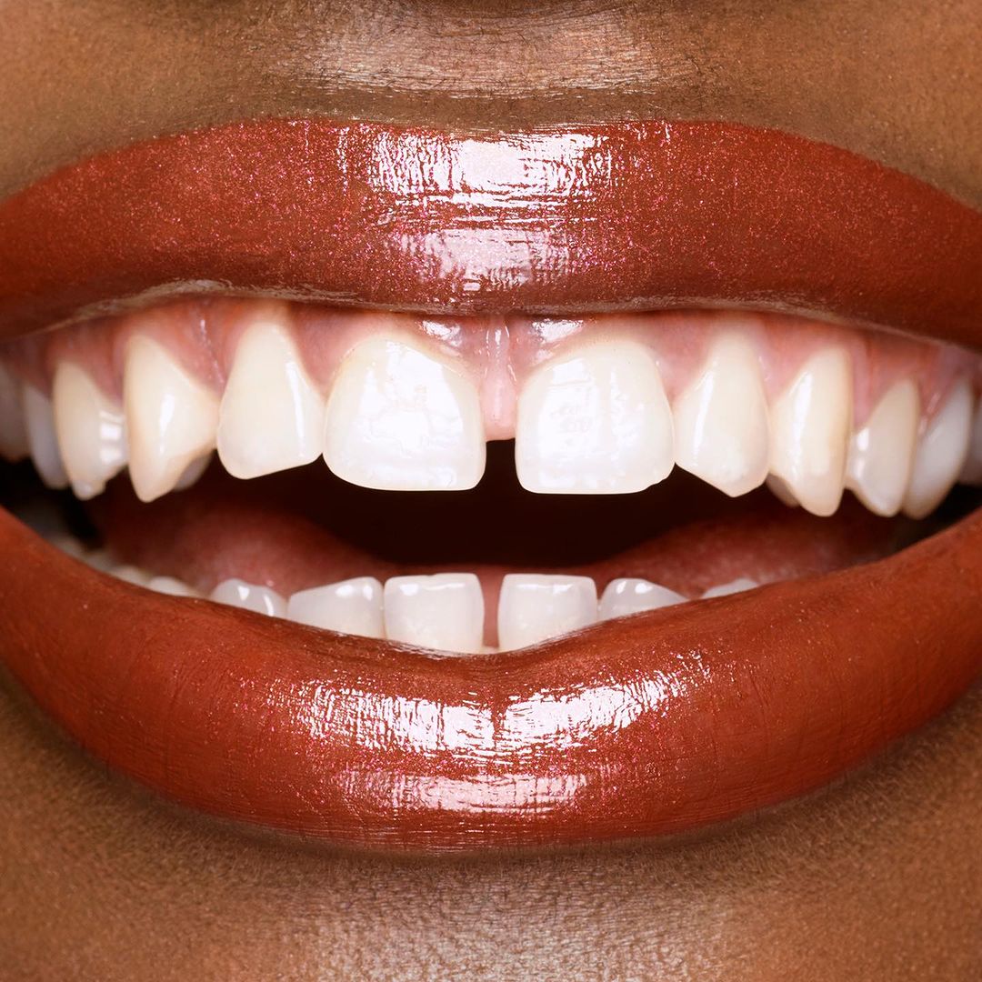 Close-up of an open mouth showing teeth and glossy, copper-colored lips on a woman with dark skin. The focus is on the dental details.