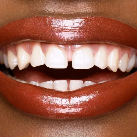 Close-up of an open mouth showing teeth and glossy, copper-colored lips on a woman with dark skin. The focus is on the dental details.