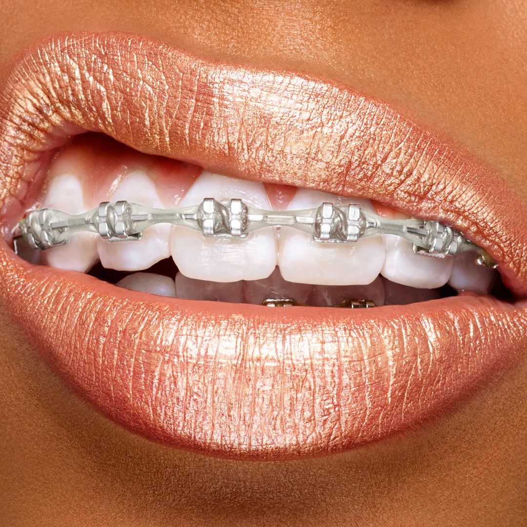 Extreme close-up of a person's mouth with shiny bronze lipstick and visible clear braces on their teeth, creating a beauty-focused dental image.
