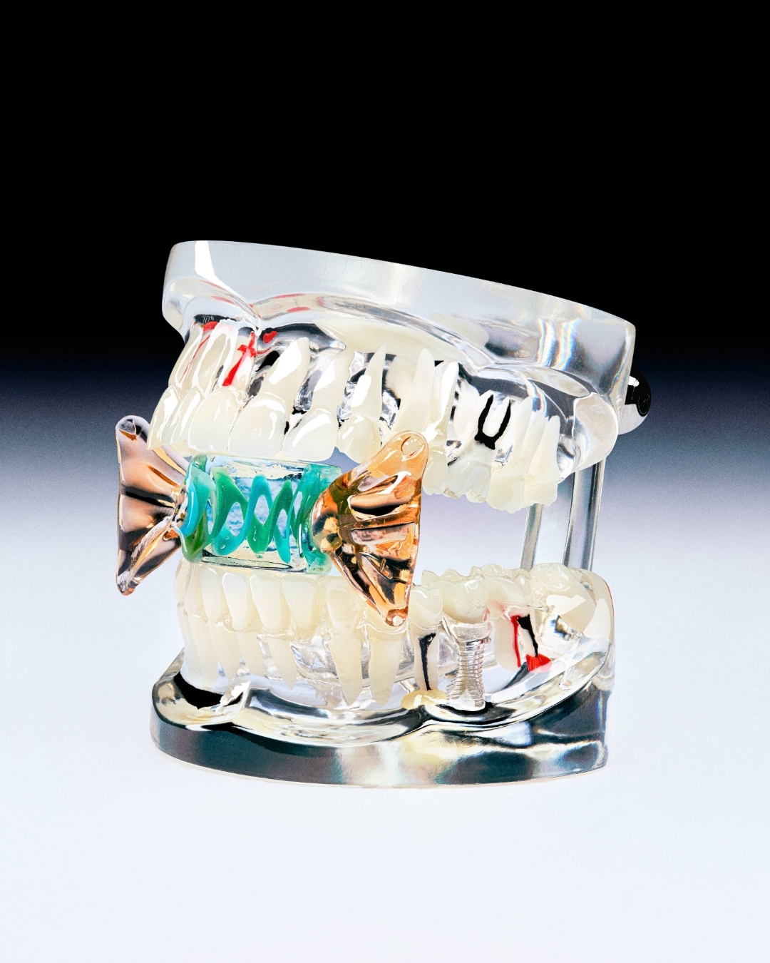 Dental model with teeth, gums, and artificial orthodontic appliances against a white and black gradient background in a studio shot.