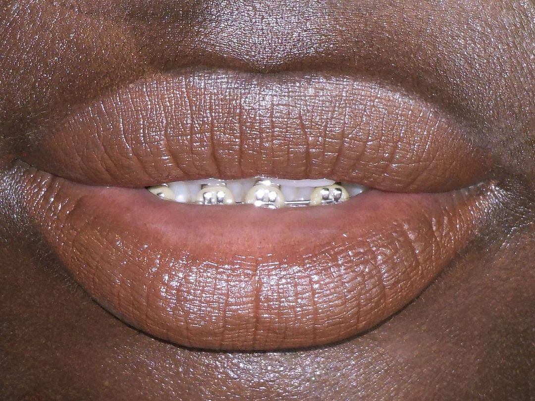 Close-up of an adult female's lips with metal dental braces, showing the upper lip and teeth in a beauty or healthcare context.
