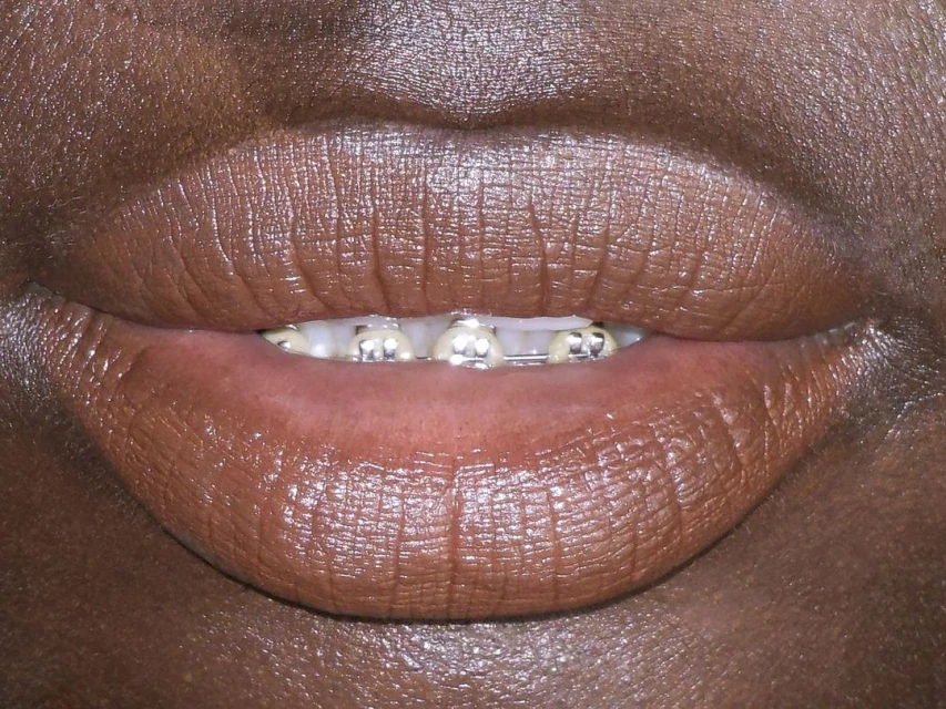 Close-up of an adult female's lips with metal dental braces, showing the upper lip and teeth in a beauty or healthcare context.