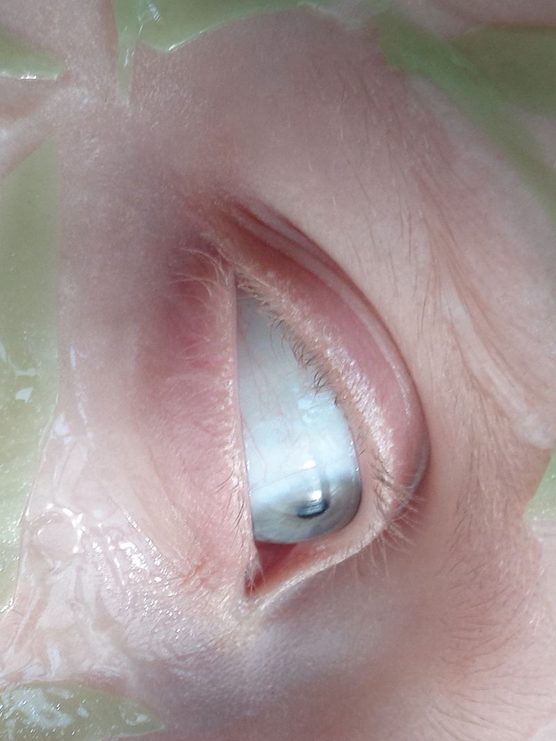 Close-up shot of an eye with a prosthetic scleral shell, showing the texture of the skin and the synthetic material.