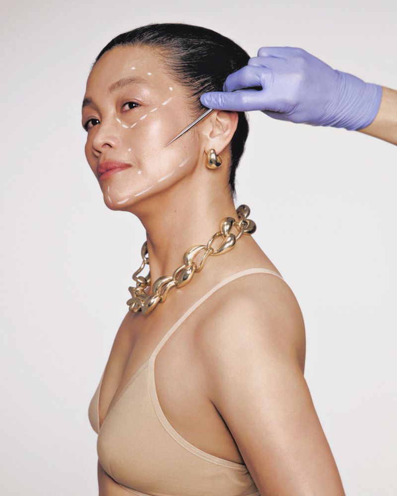 An Asian adult woman is undergoing a cosmetic procedure; blue-gloved hand holds a needle near her temple, with marking lines drawn on her face.