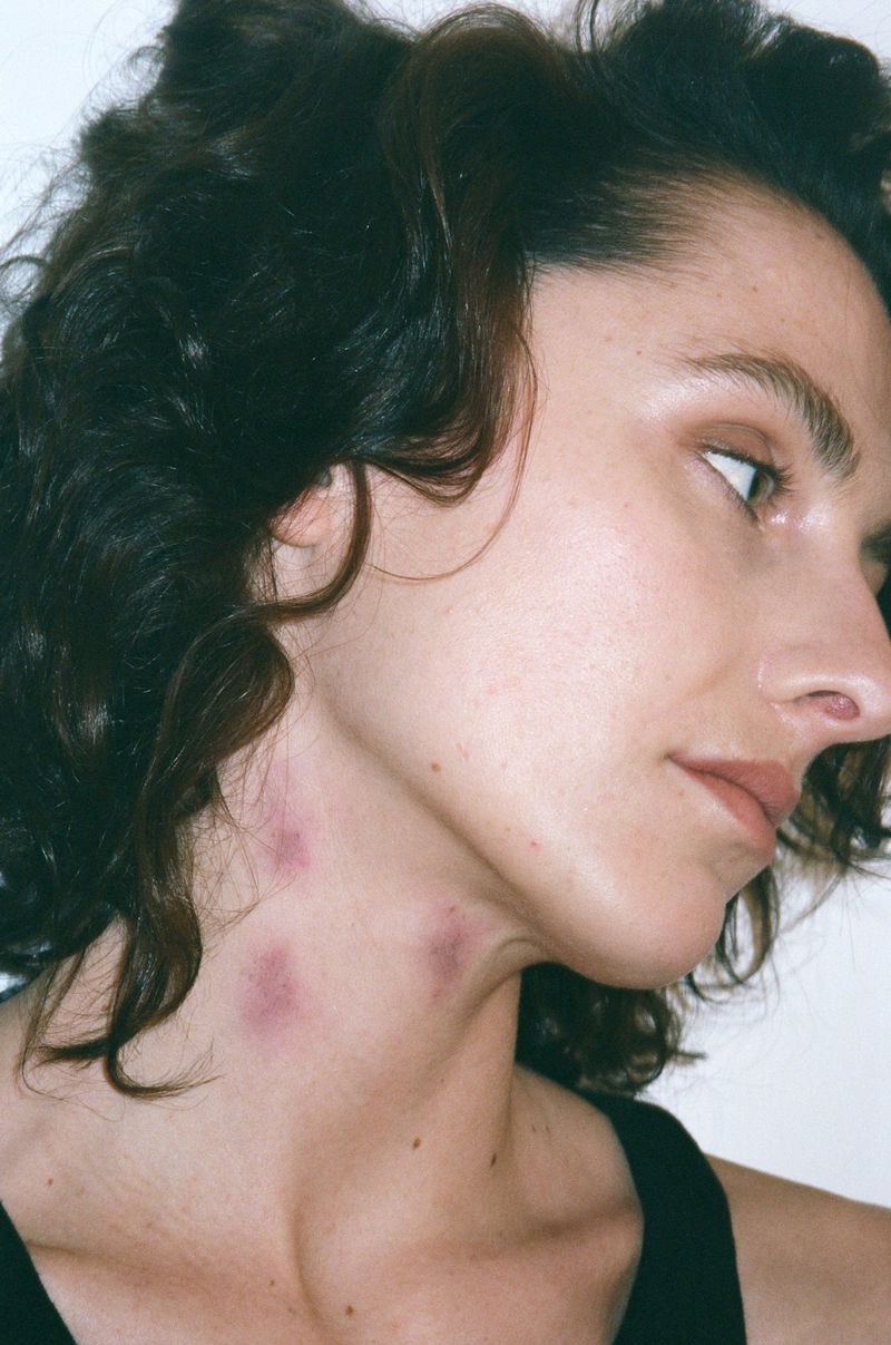Close-up profile portrait of a woman with dark wavy hair and marks on her neck against a plain background