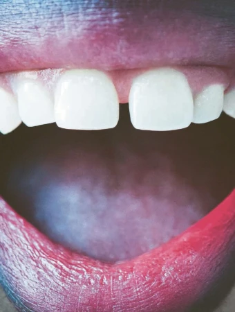 Extreme close-up of an open mouth with visible teeth and tongue. Dental health and oral hygiene are prominent in the frame.