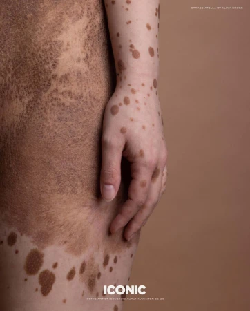 Close-up studio shot of a fair-skinned adult with brown spots and patches on their torso, arm, and hand in a portrait layout.