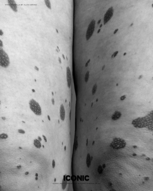 Close-up of skin texture featuring light skin tone with dark spots, creating a dappled pattern on a person's legs in monochrome.