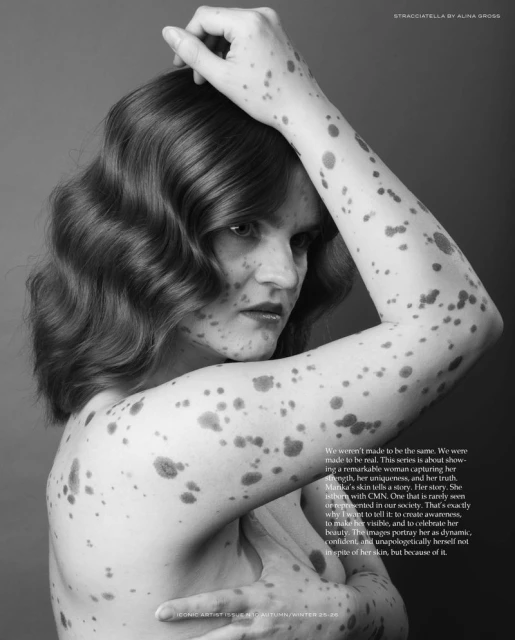 Striking black and white portrait of woman with wavy hair and skin condition, arm raised above head, against a gray backdrop.