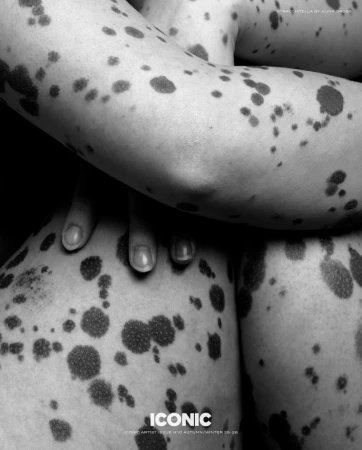 Monochrome image of human skin covered in dark spots, focusing on texture and contrast in a close-up, artistic presentation.