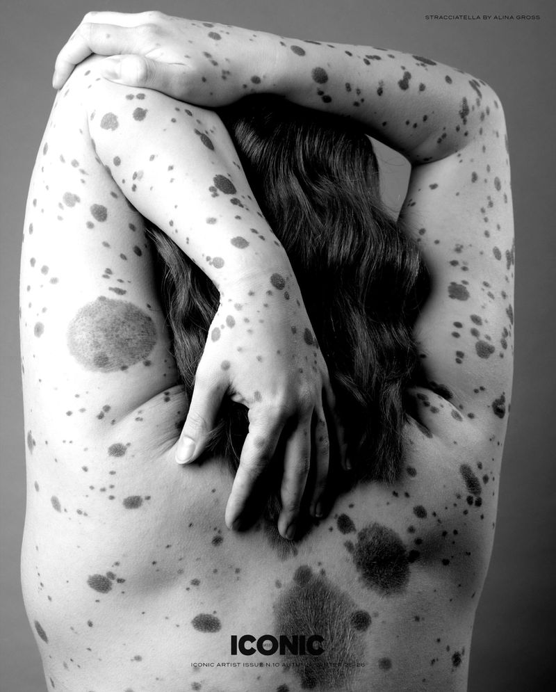 Black and white portrait of a person's back and arms covered in dark spots, with hands clasped behind the head