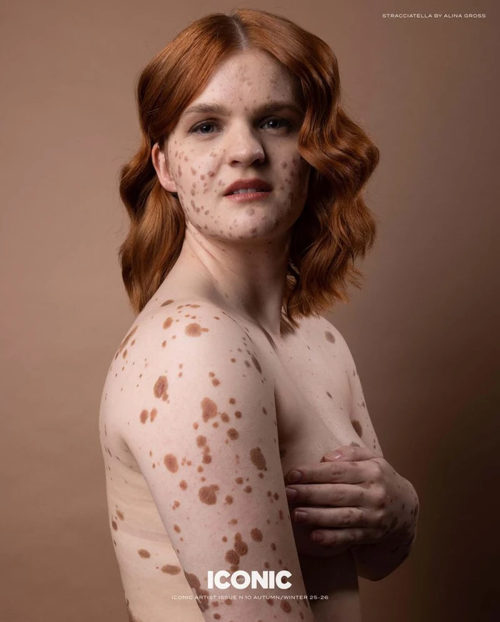 Red-haired woman with distinctive pigmentation marks across her skin posing topless against a warm beige seamless studio backdrop.