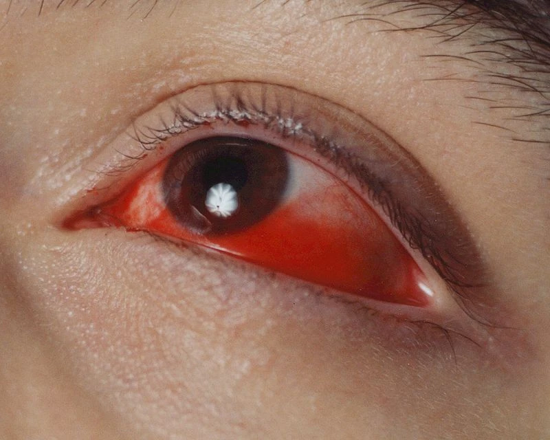 Close-up of an adult human eye with bloodshot sclera and visible eyelashes, brow, and skin texture on a neutral background.