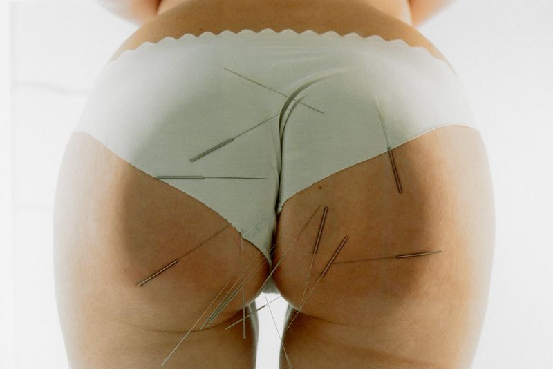Close-up of a person in white underwear with acupuncture needles, set against a bright white backdrop, emphasizes alternative therapy.