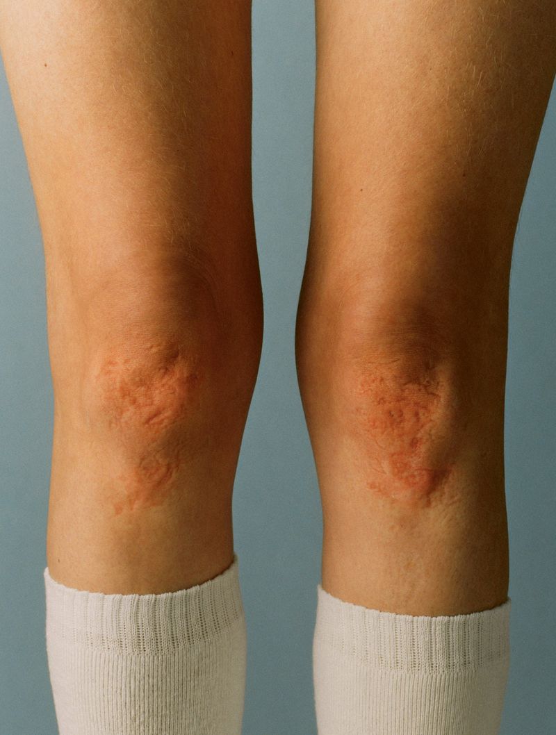 Close-up of two legs showing skin irritation around the knees and white socks on a blue background. Health and wellness concept.