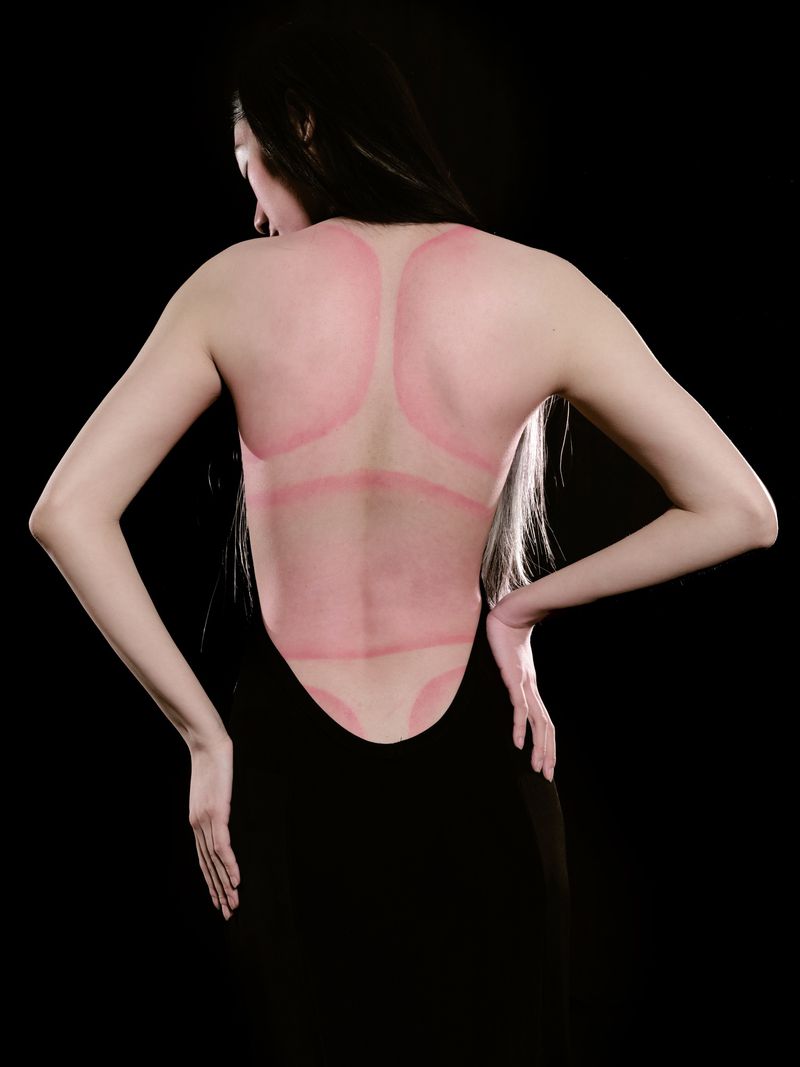 An Asian woman with long black hair poses from behind in a black dress, showing red marks from cupping on her back against a black background.