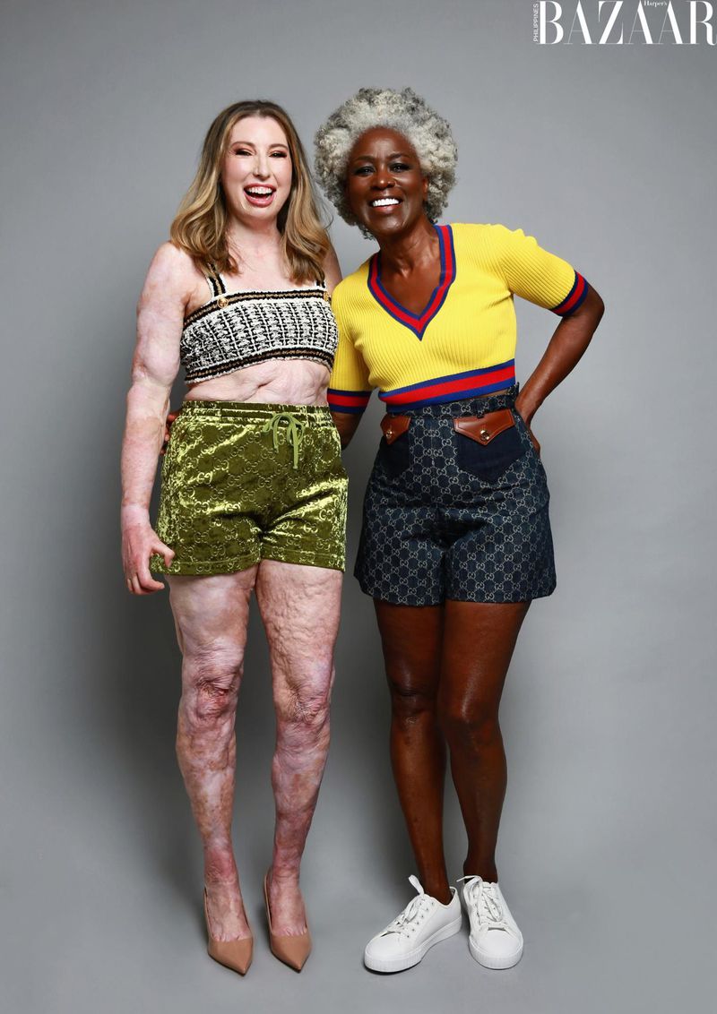 Two women in shorts pose against a grey background. One is fair-skinned with burn scars; the other is African American with grey hair.