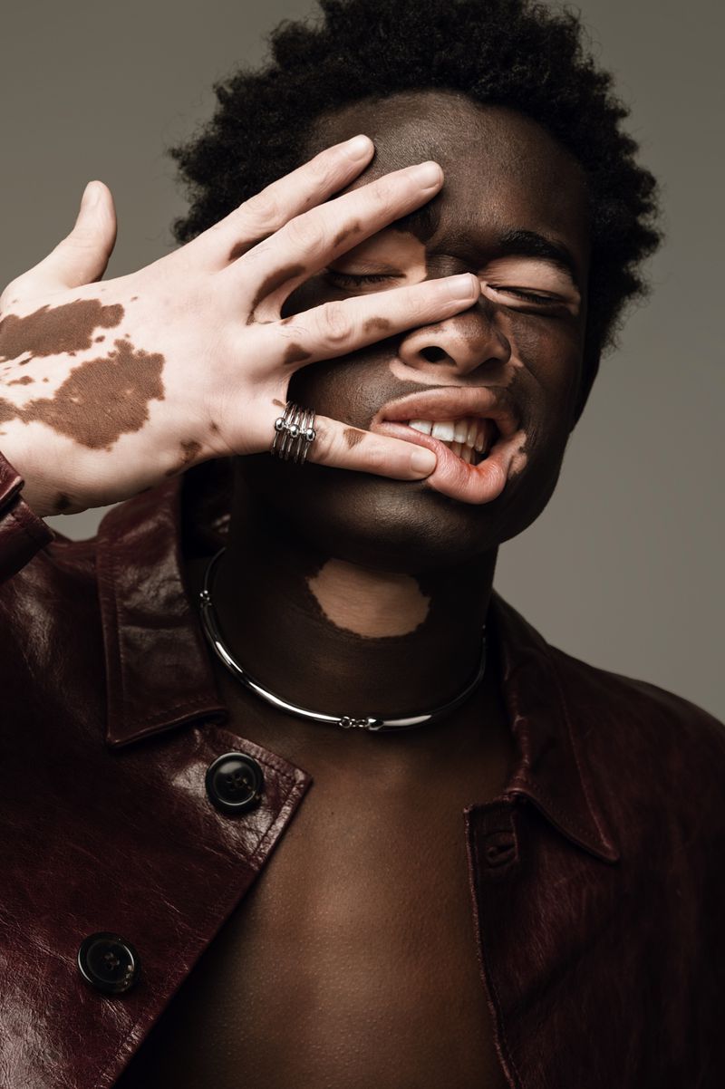 Close-up studio portrait of a Black man with vitiligo wearing a maroon leather jacket and necklace, covering half his face with his hand.