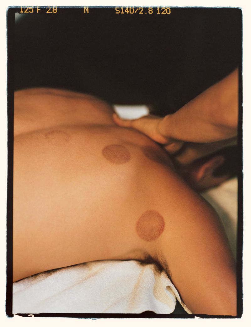 Adult male lying on a massage table receiving cupping therapy with several round marks on his back in an indoor setting.
