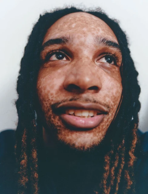 Close-up portrait of a young adult male with locs looking upward, featuring skin with vitiligo, shot at eye-level against a white background.