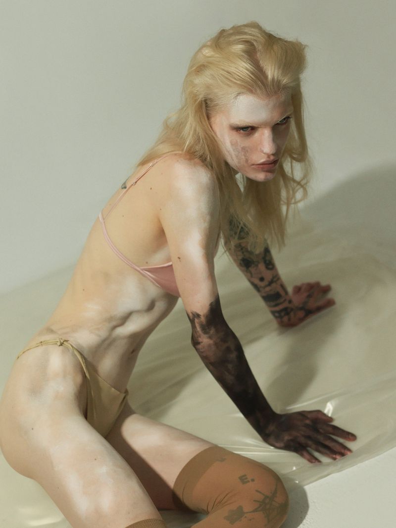 Blonde adult female poses in lingerie and stockings in a studio. Her skin is visibly affected by depigmentation, with one dark arm. 